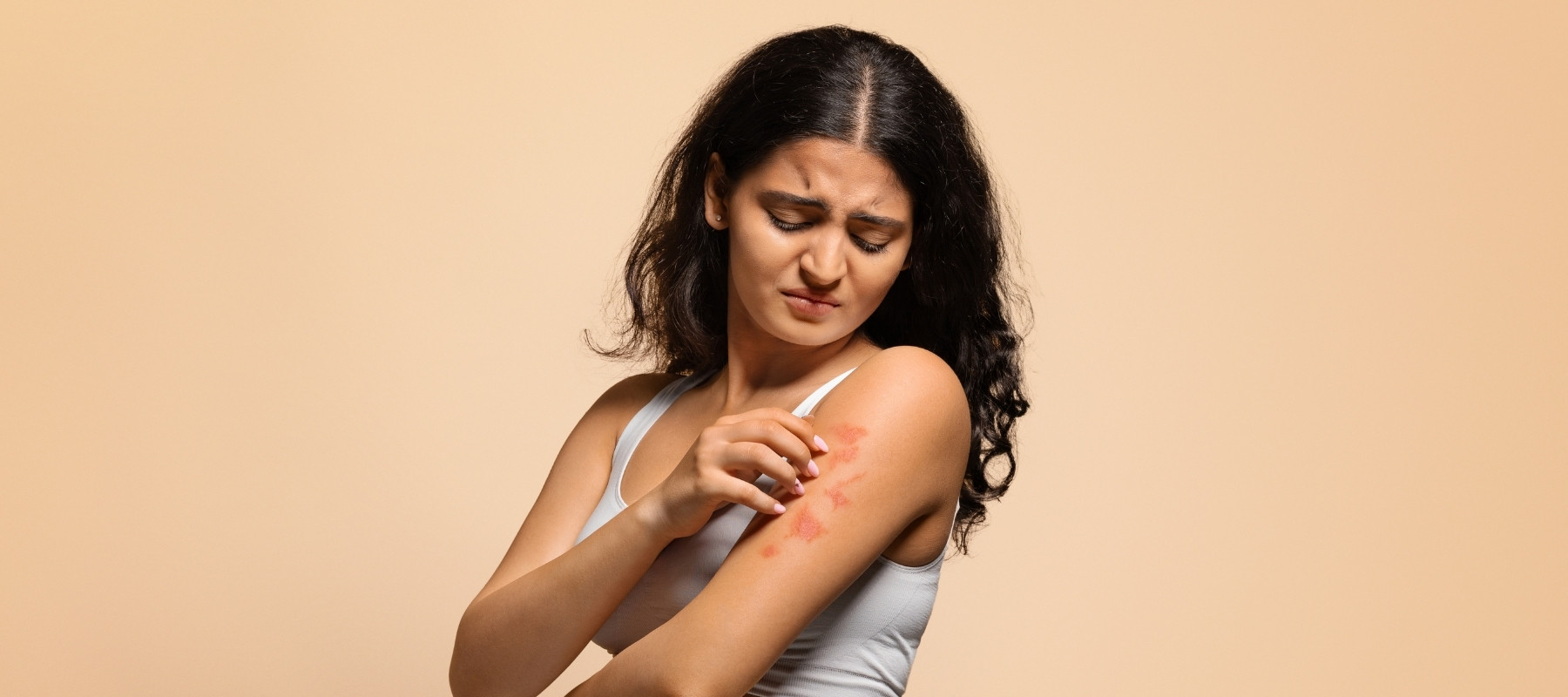 Dermite séborrhéique : tout ce que vous devez savoir