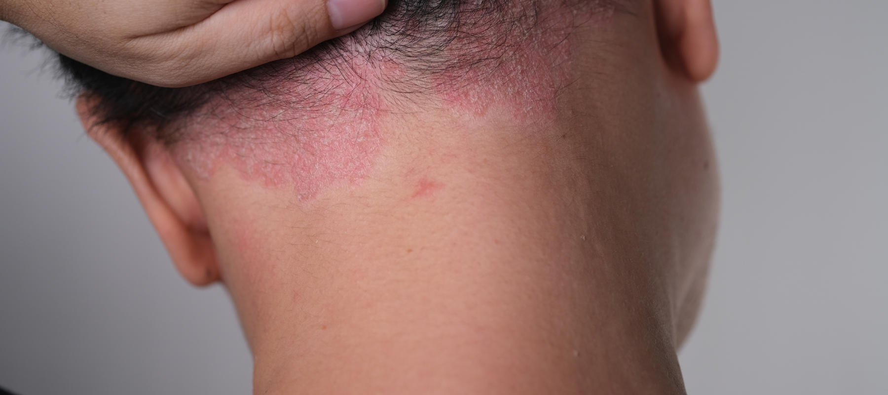 Mieux comprendre le psoriasis du visage pour mieux vivre avec